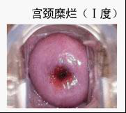 昆明女性宫颈糜烂症状有哪些？