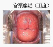 昆明女性宫颈糜烂症状有哪些？