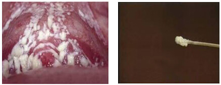 昆明女性白带豆腐渣是怎么回事？