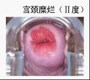 昆明女性宫颈糜烂症状有哪些？