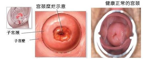 昆明女性宫颈糜烂都有哪些症状？